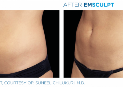 Emsculpt_PIC_Bacardfemaleabdomen011_ENUS100